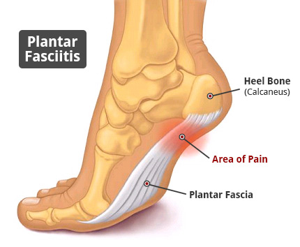 Plantar Fasciitis Sysmtoms The Sports Medicine Store LLC